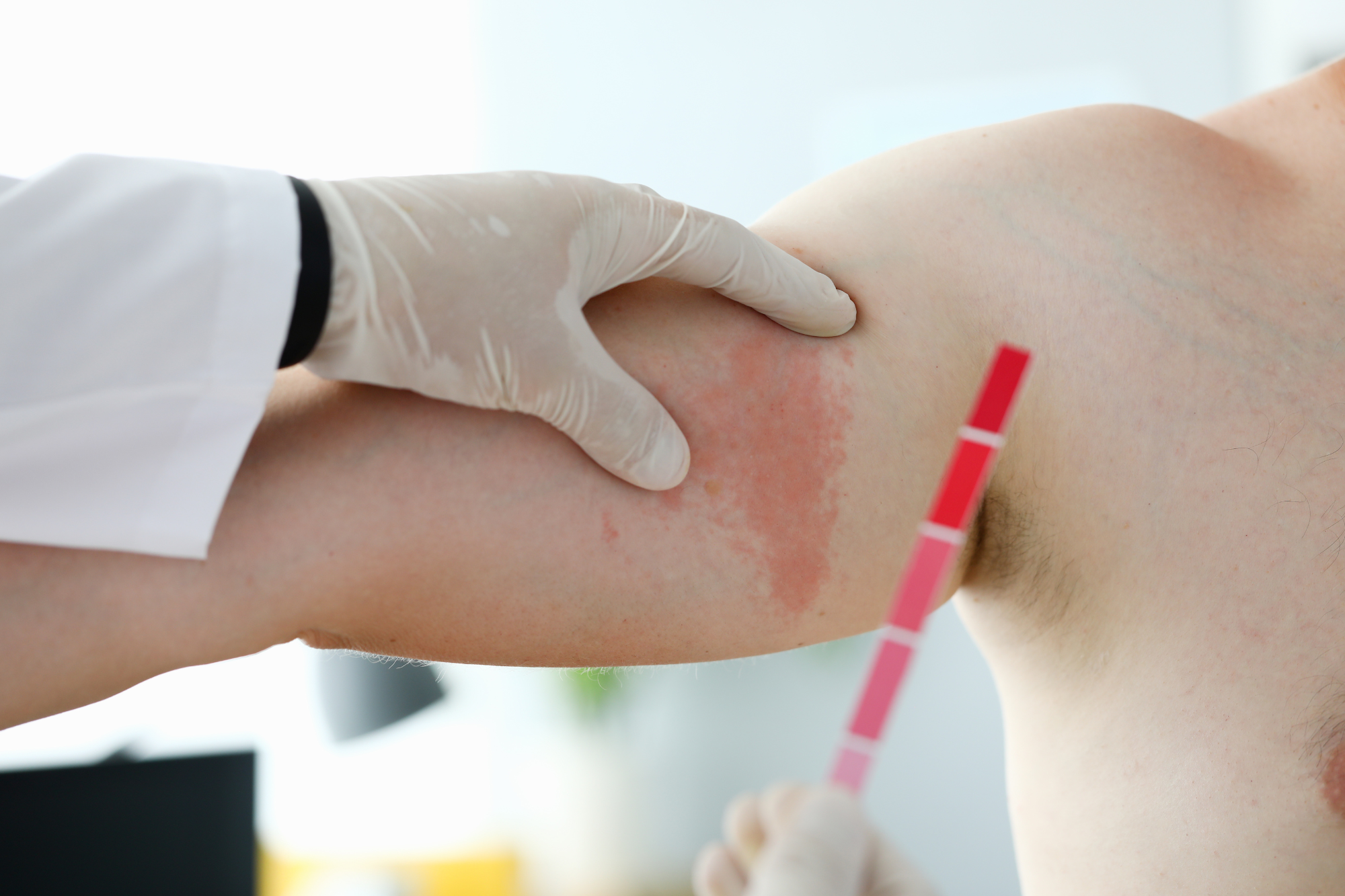 dermatite-atopique-allergie-acariens